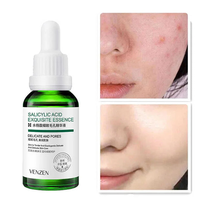 Venzen salicylic acid exquisite serum 30ml - Hopshop